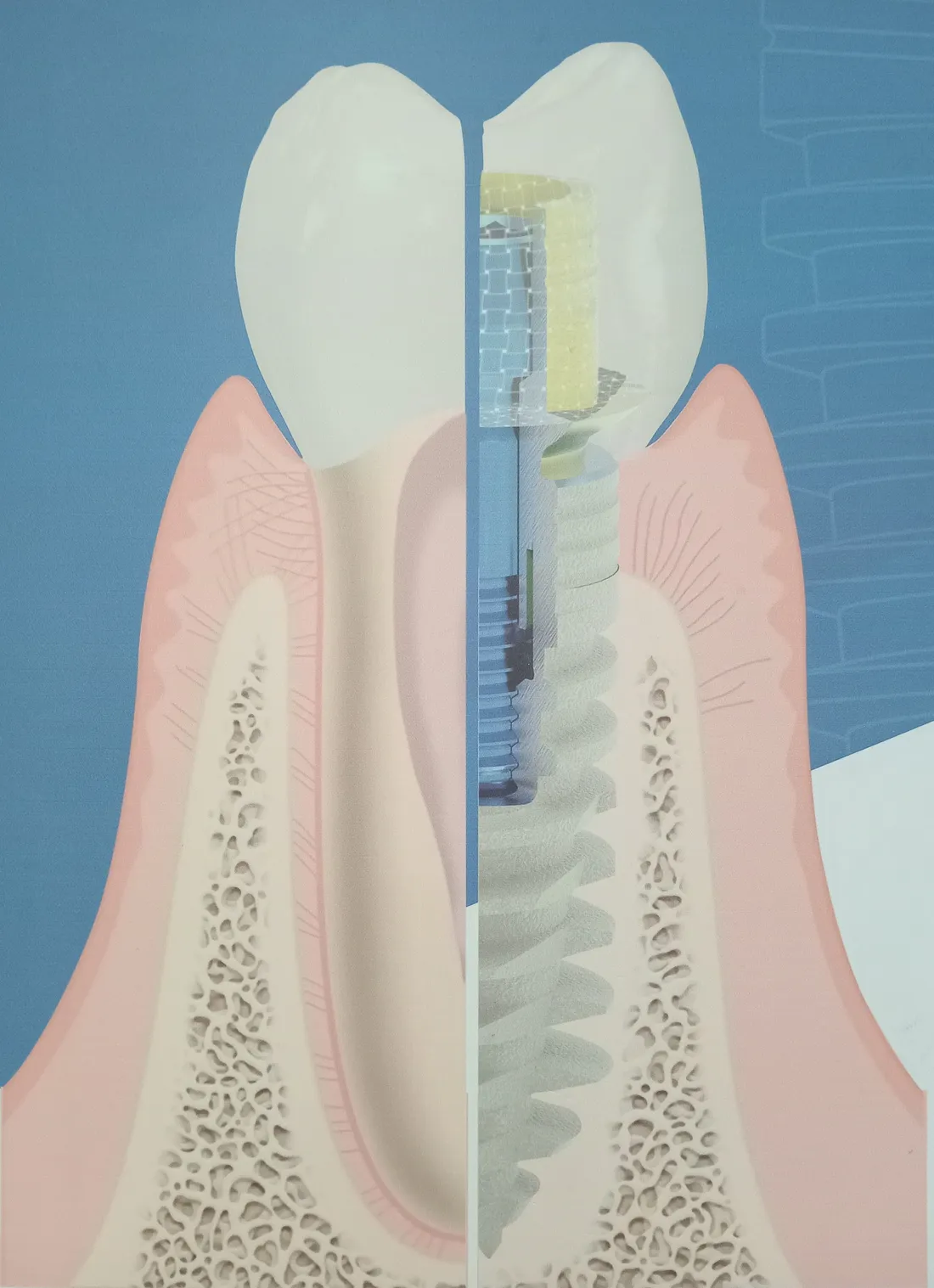 Ilustración de un implante dental de titanio con corona junto a un diente natural